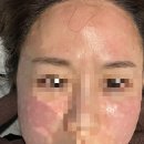 일퍼센트성형외과의원 | 일퍼센트 성형외과 올리지오 600샷 시술 후기