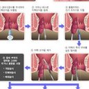 치핵 증상 및 원인과 치핵 자연치료 이미지