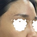 다크린 | 이마 좁쌀 여드름 2편.. 카프리 레이저 5회 내돈내산 효과 + 약처방(미노씬캡슐)