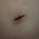 아주항외과의원 | [송도 병원기록] 피지낭종 제거 수술 후기