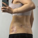 어서멍 | 복부무한람스+러브핸들(당일+7일)사진 후기/멍,붓기빨리 빠지는 꿀팁/통증 및 일상생활 가능