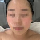 물방울세탁 | 군산피부관리 조촌동피부관리 탑뷰티 물방울리프팅 후기