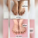 바른의수족제작연구소 | 단 2회 만에 변화가 나타난 무지외반증 교정 사례 청주 바른걸음연구소 실제 후기