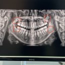 청산-4 | 광주 매복 사랑니 발치 후기 매복 4개 드디어 청산..발치 비용 및 통증
