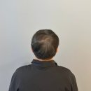 에스디메디칼 | [영종도 두피문신] 70대 남성 탈모 커버 SMP 3회차 후기! (10년은 젊어진 확연한 밀도 변화) / 스칼프...