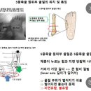 평화보건지소 | 5중족골 골절 수술 후기 1