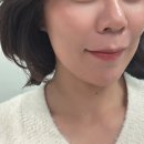 채운 | 압구정성형외과 필업 볼륨콜라겐 앞광대 꺼짐 채운 후기