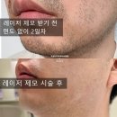 대구피부과, 젠틀맥스 레이저제모 내돈내산 후기