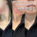 서면 인모드 잘하는 곳, 부산 인모드효과 좋은 피부과 추천