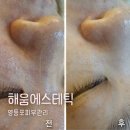 영등포피부관리 신풍역 해움에스테틱 3D 정밀진단 후 모공 케어 후기