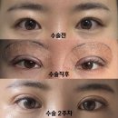 쌍수절개 재수술 발품팔아 찾은 리아이성형외과에서 윗트임 쌍수 후 + 가격 붓기 ▶2주차