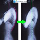 자목 | 목디스크 치료의 핵심 역C자목 일자목 거북목 교정 도수치료와 도수운동 물리치료 척추위생 조심해야 할...