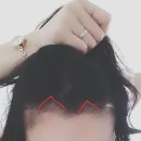 플래닛성형외과의원 | 황당했던 두드림모발이식 1000모 80만원 이벤트 찐 후기