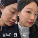 혜당생활과학 미남점 | 일산 정발산피부과에서 볼뉴머600샷 받고 1주일 뒤 후기 남겨요(리프팅 추천!)