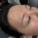 한남동 피부과 여드름 흉터 제거스킨부스터 트리필프로기기 올리디아마요 시술 후기