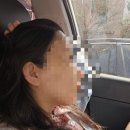 [결혼준비]귀필러 후기