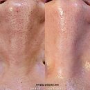 사하구-68 | 사하구 다대동 피부관리실 슈퍼젝션 3일차가 중요한 이유와 부작용, 주위사항 ,관리횟수에 대하여...