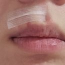 한강수성형외과의원 | 열상으로 인한 얼굴 봉합 수술 그리고 현재 2편 [흉터 전문 병원 투어 그리고 선택한 성형외과]