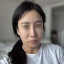 범계 | 범계역 피부과 울쎄라 후기 리프팅 변화