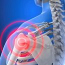 [사이언스타임즈] 21세기는 신드롬 시대 (5) 어깨충돌 증후군 “무리한 운동은 어깨에 부담 준다” 이미지