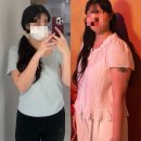 애프터 핏 | 예비신부가 선택한 팔뚝·복부지방추출주사 3개월 후기｜웨딩드레스핏 비포애프터