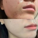 지루성피부염 모낭염 화장품 추천 지루샵 세라케어 울트라 로션 2주 사용후기