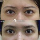 지제이성형외과 앞트임 복원 전 꼭 알아야 할 포인트 흉터 회복기간, 사례, 관리법까지 총정리