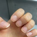 디에스타의원 | 수원 광교 네일아트 동시시술 가능한 ‘테디네일’