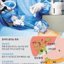 담석이 癌 된다?… 肝내 담관에 생겼다면 위험 이미지