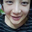 (네잎클로버)양악+윤곽 D+63 후기 이미지