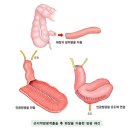 방광암 치료 방법( 인공 방광 조성술 / 요루 주머니 시술) ​ 이미지