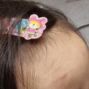 한강수성형외과의원 | 아기이마 봉합수술 레이저치료 2년 진행후기