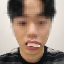 MTA 참 태권도 | 경북 포항 치근단절제술 후기 비용 통증 시간