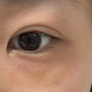 200 | 부산피부과추천 울트라콜200 눈밑꺼짐 후기 내돈내산 솔직후기