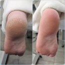 이천 문제성 발 전문 라파엘 각질케어 예약방법 및 후기