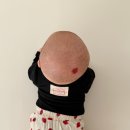 오즈약국 | 100일 여자 아기 두피 혈관종 부산 오즈피부과의원