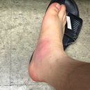 부주상골증후군 척수신경말초지차단술 주사 치료 후기