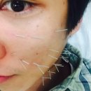 여긴 신세계 오바. 어려지고,탱탱해지고,이뻐지는 동안침 후기