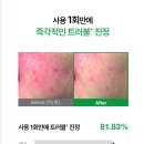 디오디너리샵 | 내돈내산 후기 | 아누아 어성초 77 비3징크 트러블 세럼 | 나이아신아마이드 5% | 한달 사용 후기