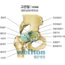 [고령층 고관절 골절시 위험 , 인공관절수술 치료 & 고관절 통증 & ] 이미지