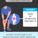 무릎에 물찼을때 증상 다양한 무릎에 물이 차는 이유 이미지