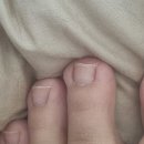 씨유 병점그린점 | 일상 ☁️ 병점역점 <레푸스> 내성발톱 치료 상담 및 1차교정 내돈내산 후기/가격
