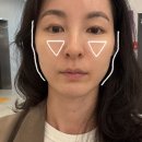 영종도 피부과 쥬베룩볼륨 후기 땅콩형 얼굴 볼패임 탈출 내돈내산