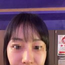 NO.1 자동차피부과 | 홍대입구역피부과 앞볼필러 동안얼굴 솔직후기