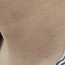 동의한의원 | [화접몽한의원 강서목동점] 거우침 한 달 경과 후기 쥐젖 사마귀제거