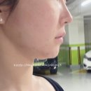 동탄피부과 쥬베룩 볼륨 풀페이스 리볼르 솔직후기, 통증, 다운타임, 부작용,결절