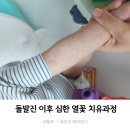 본터휴 | 돌발진 심한 열꽃 후기 치유 과정, 관리 방법