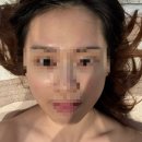 더채움 | 부천피부관리 좁쌀여드름 전문, 더채움에스테틱 4회차 마지막 후기🌸