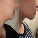 서울에스유외과의원 | 신상성형외과 이중턱 지방흡입 후기 :: 상담부터 수술 당일 4일차 내돈내산 기록(1편)
