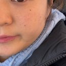 리바이브 | 부산윤곽주사 사각턱보톡스+리바이브리프팅 내돈내산후기